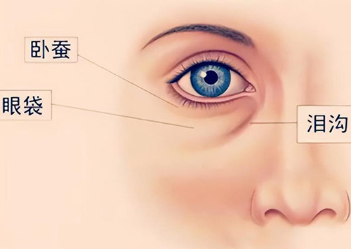 玻尿酸填充泪沟多久可以修复自然?