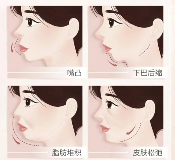下颌缘提升怎么打