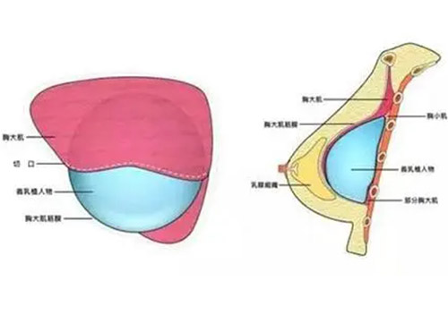 胸部假体取出后需要加压多长时间
