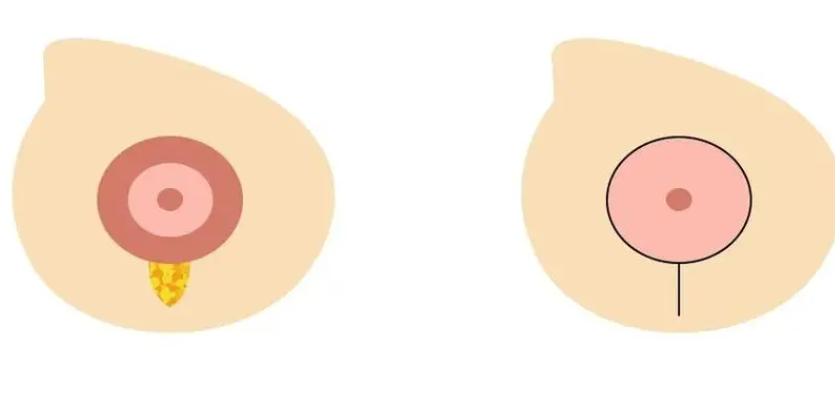 乳房下垂棒棒糖矫正法示意图