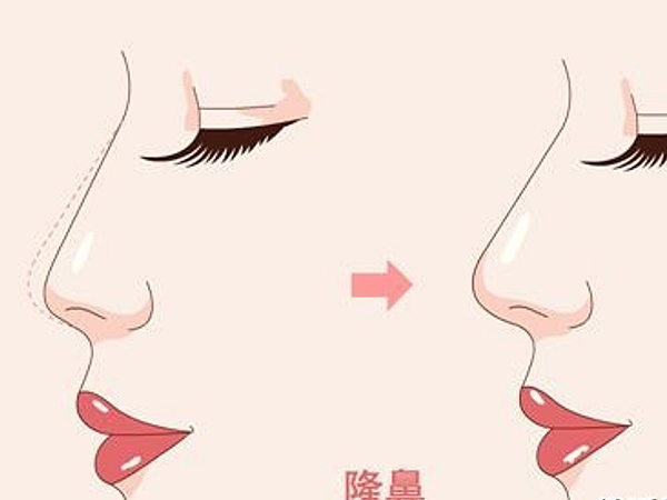肋骨鼻多久修复自然