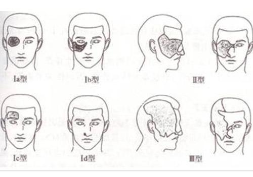 太田痣