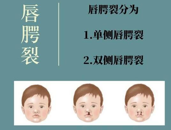唇腭裂需要做几次手术