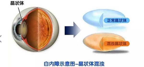 白内障