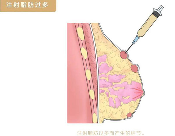 自体脂肪丰胸