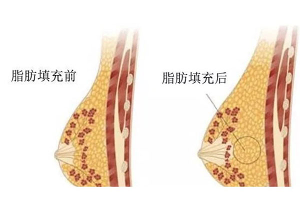 自体脂肪丰胸