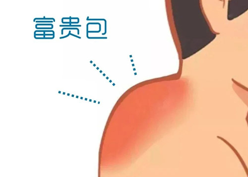 富贵包是怎么形成的