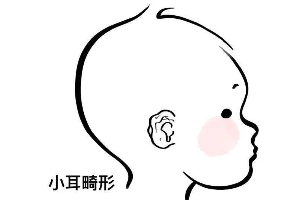 耳畸形