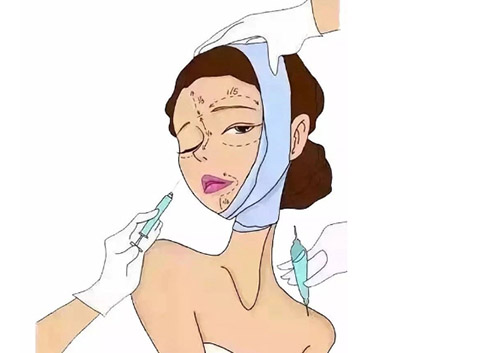 胶原蛋白填充有后遗症吗?
