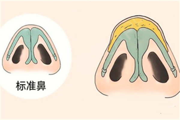 鼻孔挛缩变性
