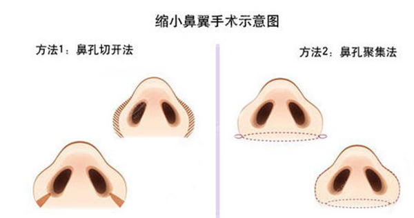 可以单独缩小鼻翼吗