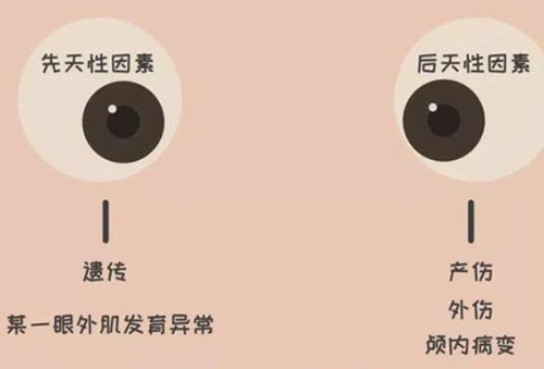 后天眼睛斜视可以矫正吗