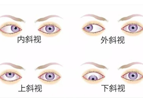 斜视眼分类