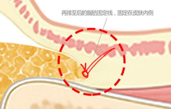 眼底脂肪重置手术