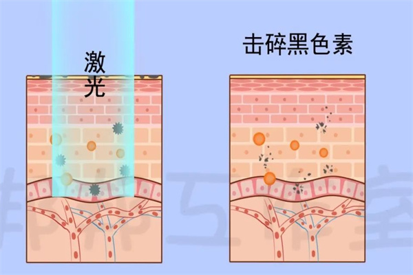皮秒激光与点阵激光的原来不同