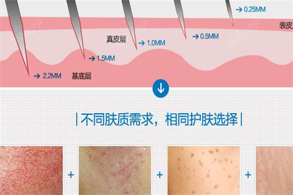 皮秒激光与点阵激光改善不同肤质