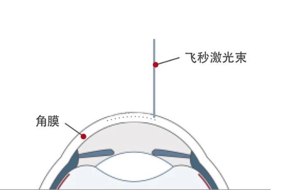 做完飞秒手术多久可以修复正常视力？