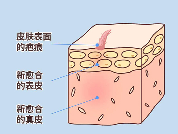 激光去疤痕有效吗
