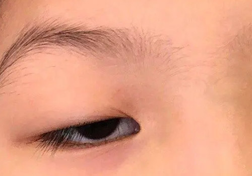 小孩上眼睑下垂是怎么回事