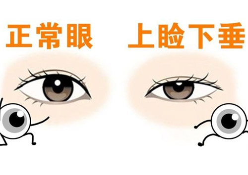 儿童上眼睑下垂是什么意思