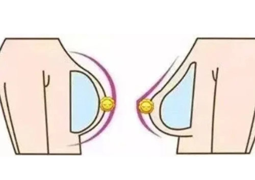 水滴型假体和圆形假体对比
