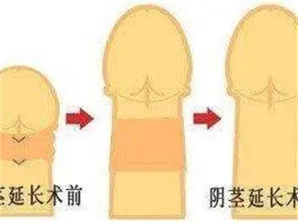 怎么才能让阴茎变长变粗