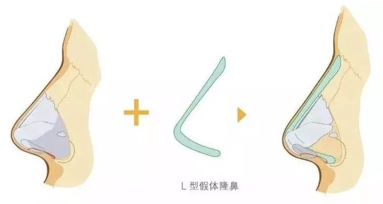 假体隆鼻