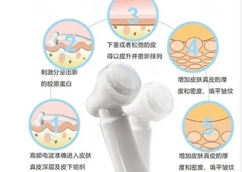 电波拉皮的作用过程