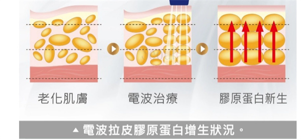 电波拉皮