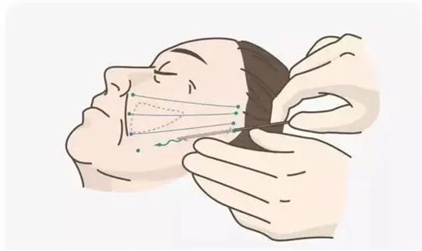 电波拉皮