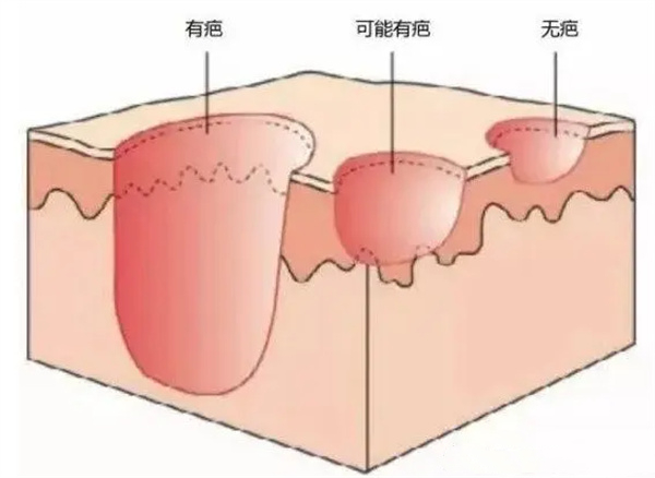 如何预防痣的恶变?