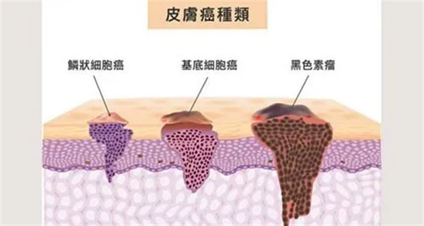 如何预防痣的恶变?