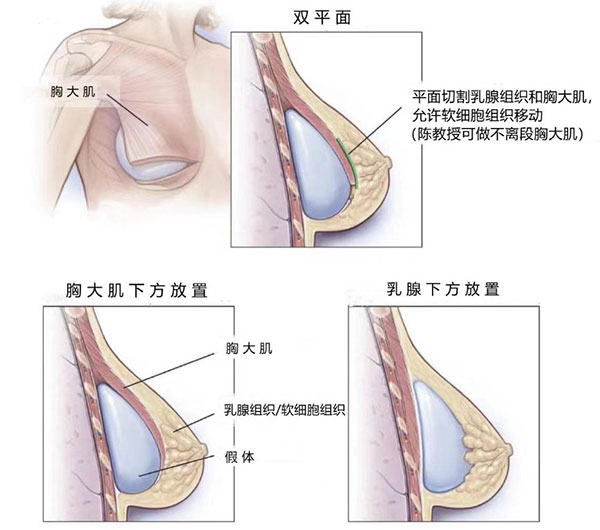 双平面丰胸