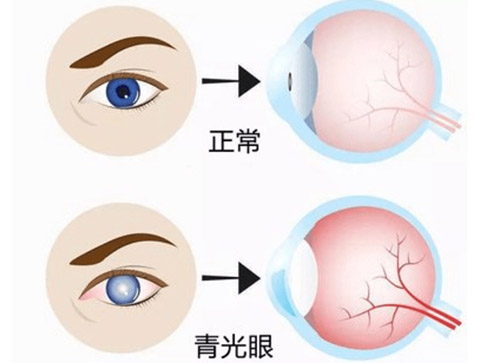 哪些人容易患上青光眼