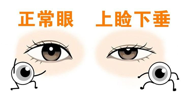 mts上睑下垂矫正治疗