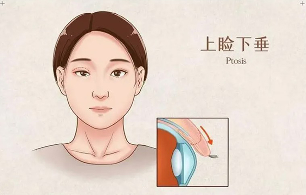 mts上睑下垂矫正治疗