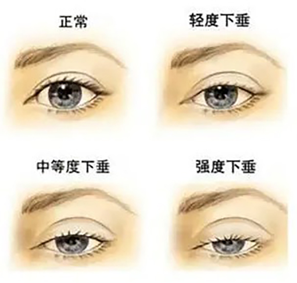mts上睑下垂矫正治疗
