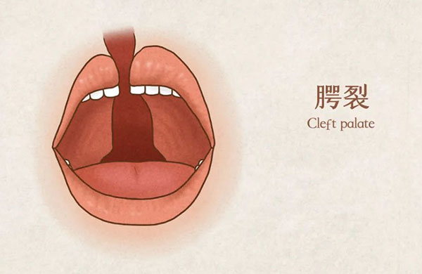 唇腭裂是什么原因造成的