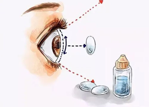 ok镜可以治疗近视眼吗