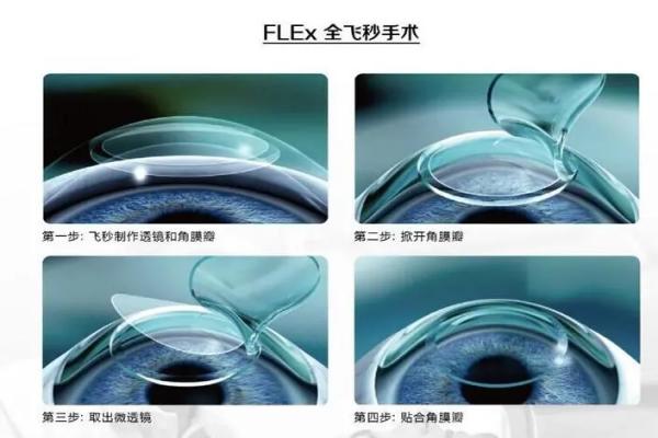 近视手术注意事项