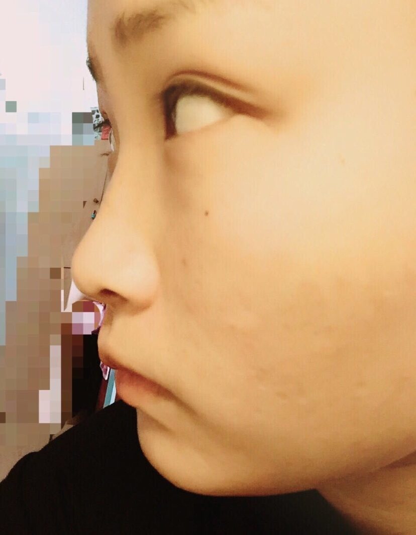 吸脂后脂肪少了，皮肤会不会变得很松啊？(吸脂和瘦脸脂，可以一起做吗？)