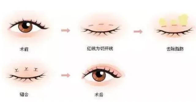 全切双眼皮多长时间变自然?