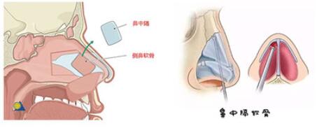 邱文苑做鼻子怎么样？医生技术点评+隆鼻真实成果参考