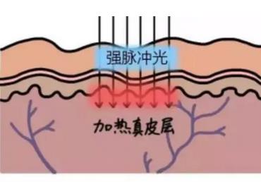 光子嫩肤的生物刺激成果如何?
