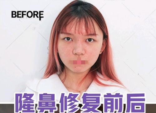 湘雅二医院方柏荣做鼻修复实例展示，医生综合实力怎么样？实例赶紧来看看