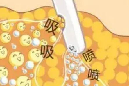 l吸脂w2.jpg