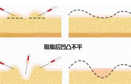 手臂抽脂有成果吗，手臂抽脂疼吗