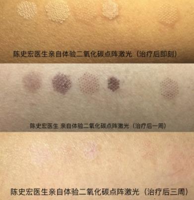 点阵激光去痘印有什么副作用?需要多长时间修复?