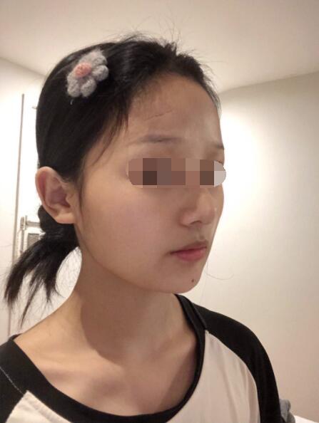 西京医院刘超华实例展示：疤痕修复术后成果让我喜出意外~