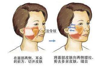 面部拉皮去皱美容价格贵得离谱吗？过程是怎么样的？本文给你好好说说